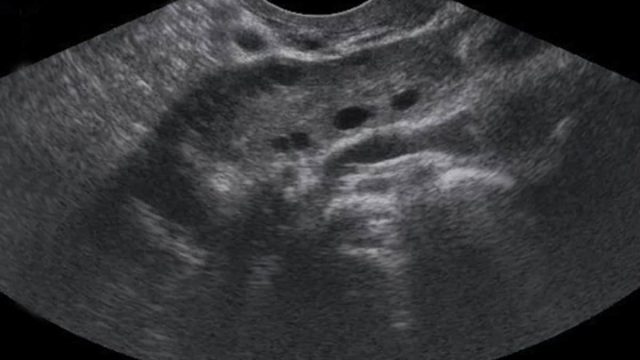 1 Normal ovary TVUS | موسوعة الشرق الأوسط