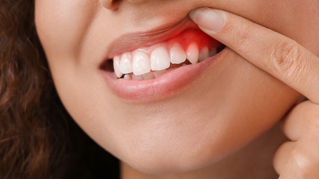 3 Stages of Gum Disease | موسوعة الشرق الأوسط