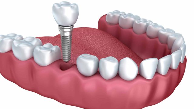 3.Dental Implant 2 | موسوعة الشرق الأوسط