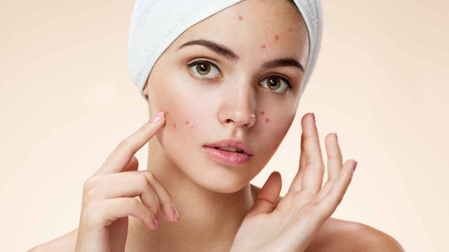 Acne Home Treatments That Dermatologists Say Work | موسوعة الشرق الأوسط