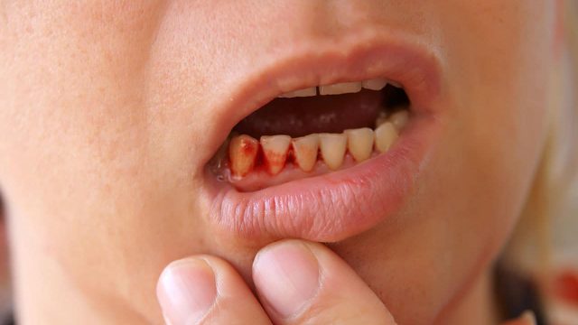 Bleeding gums | موسوعة الشرق الأوسط