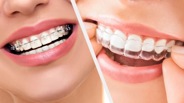 Clear Aligners Better Than Ceramic Braces | موسوعة الشرق الأوسط