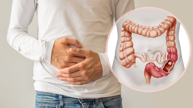 Colon Cancer Rising Young Adults | موسوعة الشرق الأوسط