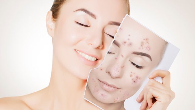 Conceal Pimples | موسوعة الشرق الأوسط