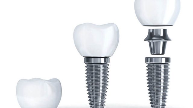 Dental Implants Myths800Sep2018 | موسوعة الشرق الأوسط