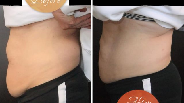 Liposuction Unwanted Fat Removal | موسوعة الشرق الأوسط