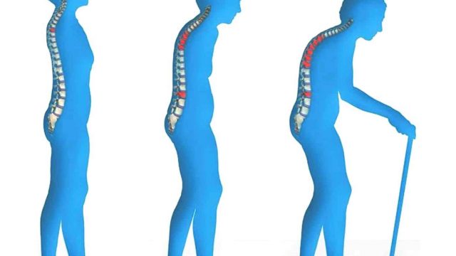 Osteoporosis | موسوعة الشرق الأوسط