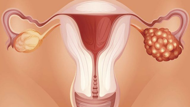 Ovarian cysts | موسوعة الشرق الأوسط