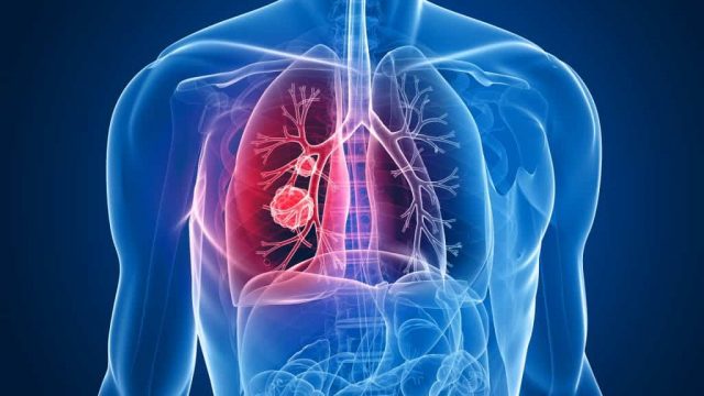 Pneumonia | موسوعة الشرق الأوسط