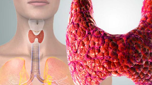 Radioactive iodine sessions | موسوعة الشرق الأوسط