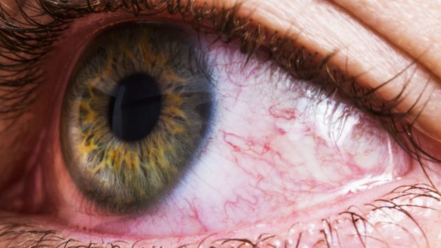 Red Eye Causes | موسوعة الشرق الأوسط