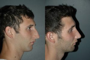 Rhinoplasty3 | موسوعة الشرق الأوسط