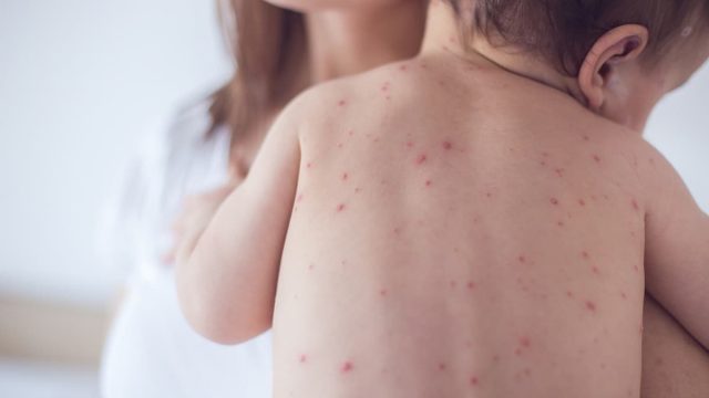 Rubella | موسوعة الشرق الأوسط