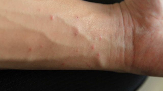 Scabies | موسوعة الشرق الأوسط