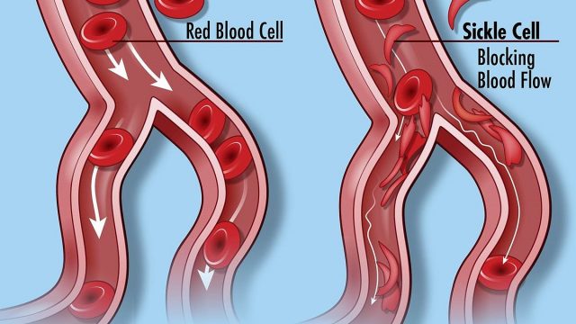 Sickle Cell Disease 27249799083 | موسوعة الشرق الأوسط