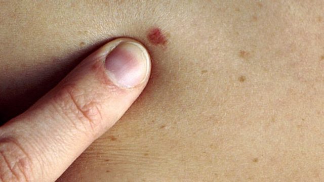 Symptoms of skin cancer | موسوعة الشرق الأوسط