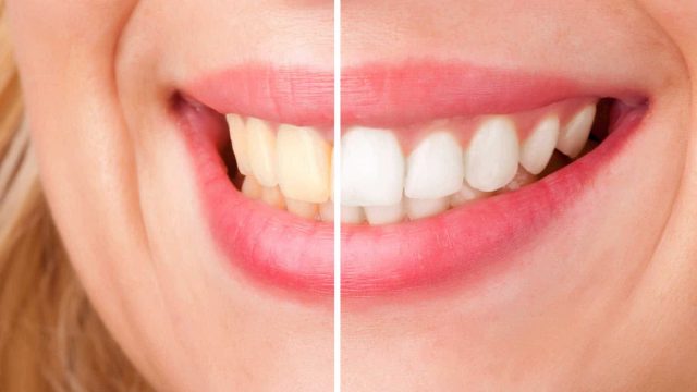 Teeth whitening | موسوعة الشرق الأوسط