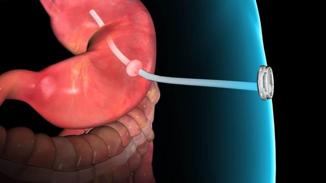 Tube 20Implanted.0 | موسوعة الشرق الأوسط