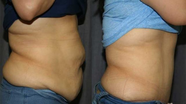 Tummy tuck after giving birth | موسوعة الشرق الأوسط