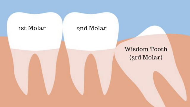 Wisdom teeth | موسوعة الشرق الأوسط