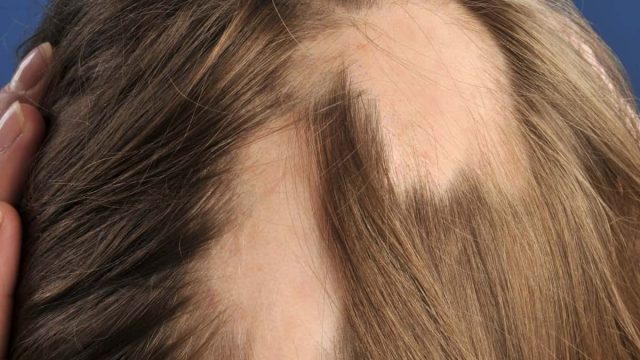 alopecia areata 4 | موسوعة الشرق الأوسط