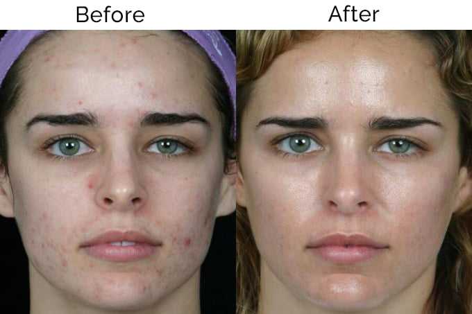 chemical peel 22 | موسوعة الشرق الأوسط