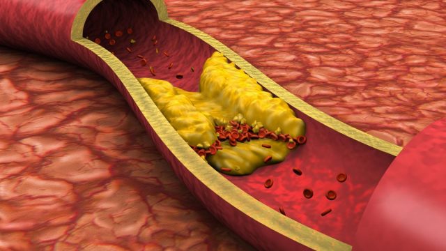 cholesterol ldl 1200x800 | موسوعة الشرق الأوسط