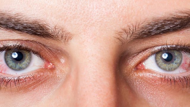 dry eye 1422 article 85252 | موسوعة الشرق الأوسط