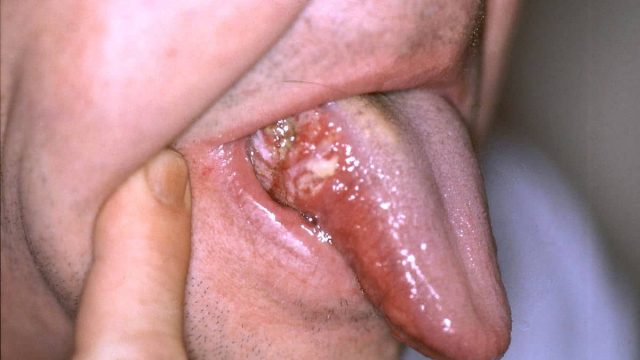 erythroplakia | موسوعة الشرق الأوسط