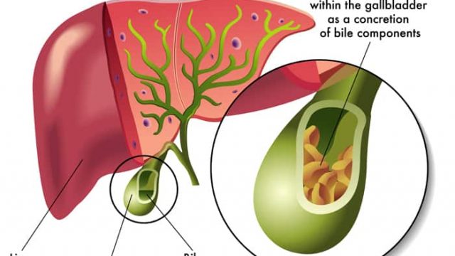 gallstones diagram | موسوعة الشرق الأوسط