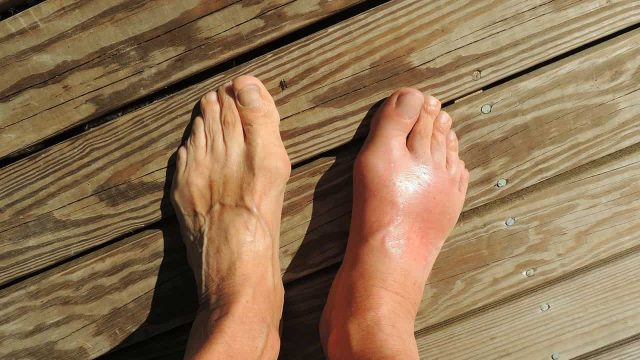 gout feet | موسوعة الشرق الأوسط