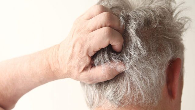 hair psoriasis | موسوعة الشرق الأوسط