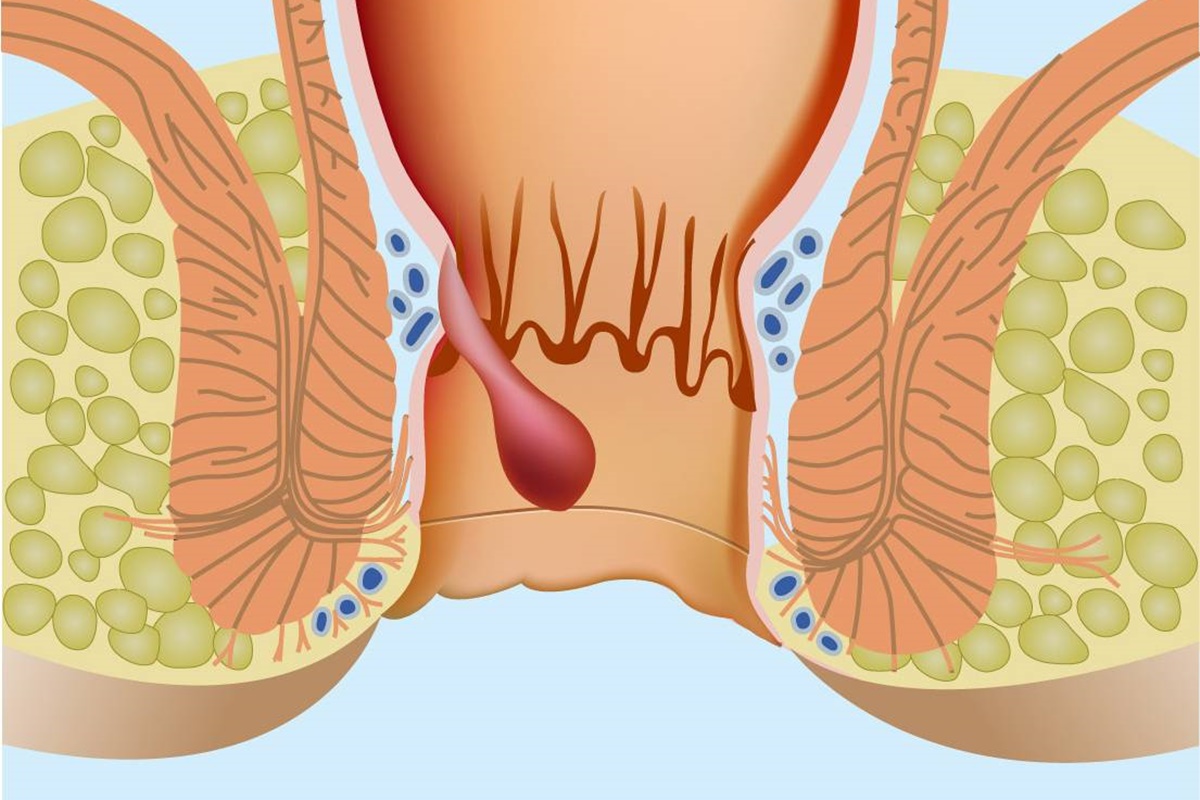 hemorrhoids1 | موسوعة الشرق الأوسط