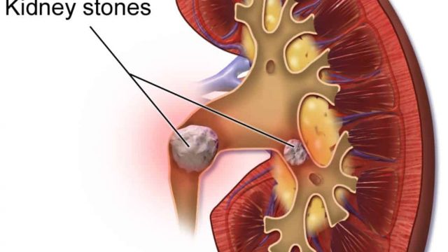 kidney stones | موسوعة الشرق الأوسط