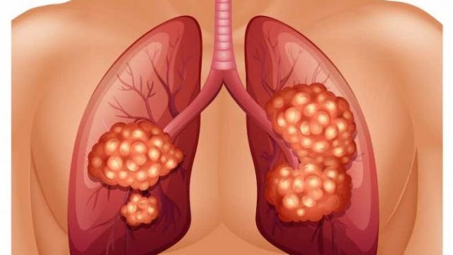 lung cancer 1 | موسوعة الشرق الأوسط