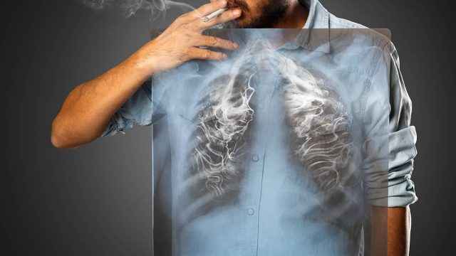 lung cancer smoking | موسوعة الشرق الأوسط