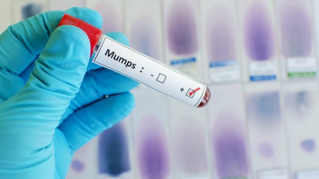 mumps 1 | موسوعة الشرق الأوسط