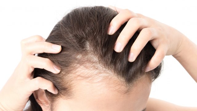 naturopathy treatment for hair loss | موسوعة الشرق الأوسط