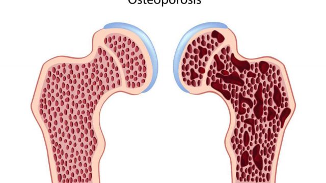 osteoporoz patogenez | موسوعة الشرق الأوسط