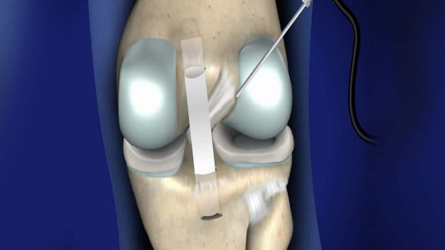 posterior cruciate ligament | موسوعة الشرق الأوسط