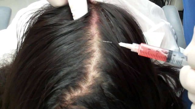 prp hair growth | موسوعة الشرق الأوسط