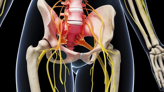 sciatica treatment | موسوعة الشرق الأوسط