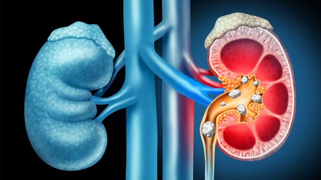 social nierensteine harnsteine ksw | موسوعة الشرق الأوسط