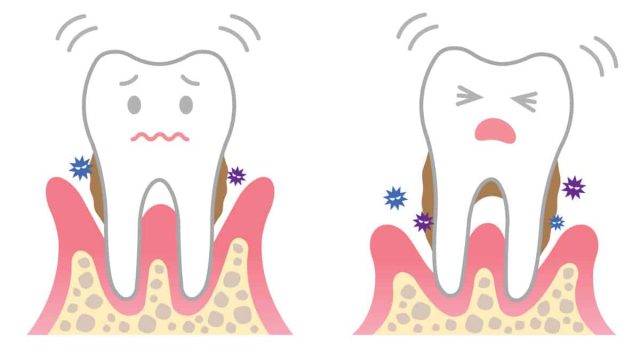 teeth clipart gingivitis 9 | موسوعة الشرق الأوسط