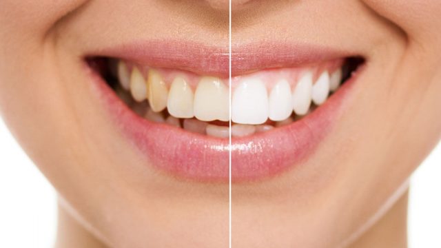 whitening | موسوعة الشرق الأوسط