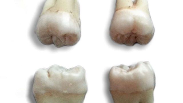 wisdom tooth extraction 4e0eabde2cfe123ab505d697fa58aef5 | موسوعة الشرق الأوسط