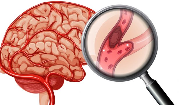 آثار الجلطة الدماغية | موسوعة الشرق الأوسط