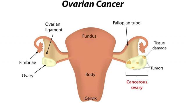 أعراض سرطان المبيض الخبيث | موسوعة الشرق الأوسط