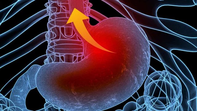 أفضل علاج للارتجاع البلعومي الحنجري | موسوعة الشرق الأوسط