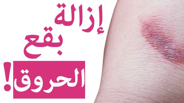 إزالة آثار الحروق القديمة بسرعة | موسوعة الشرق الأوسط